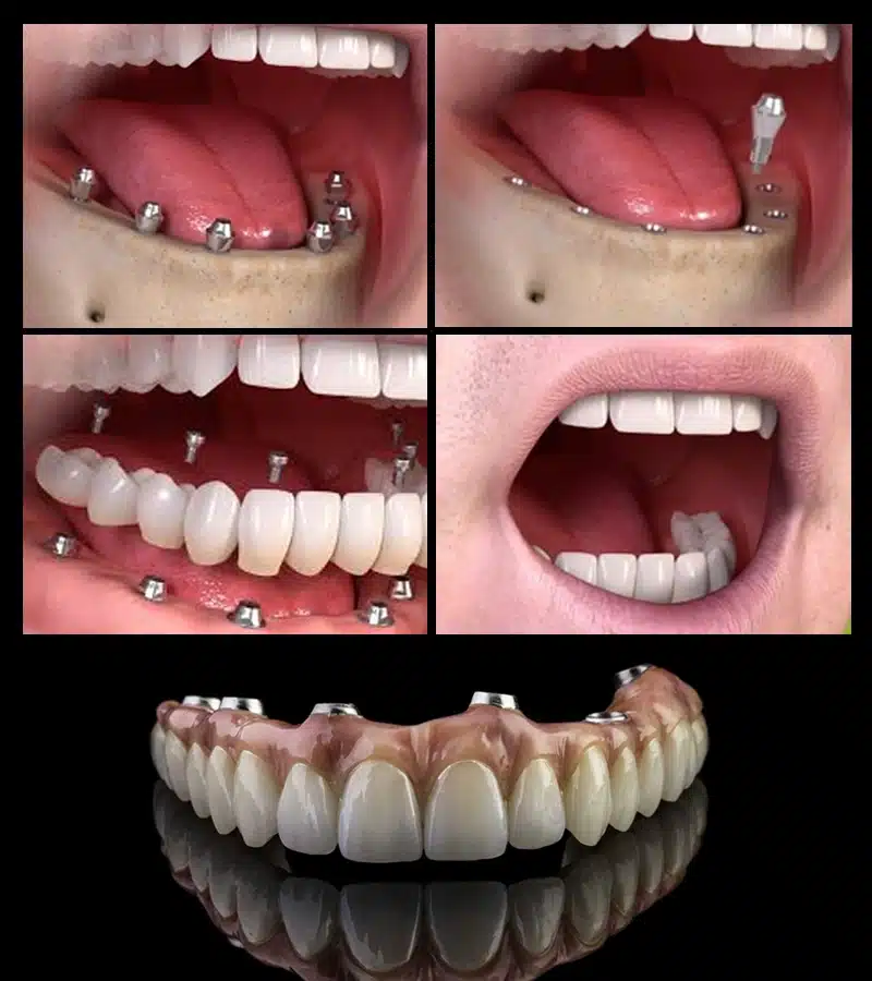 Full Mouth Rehabilitation